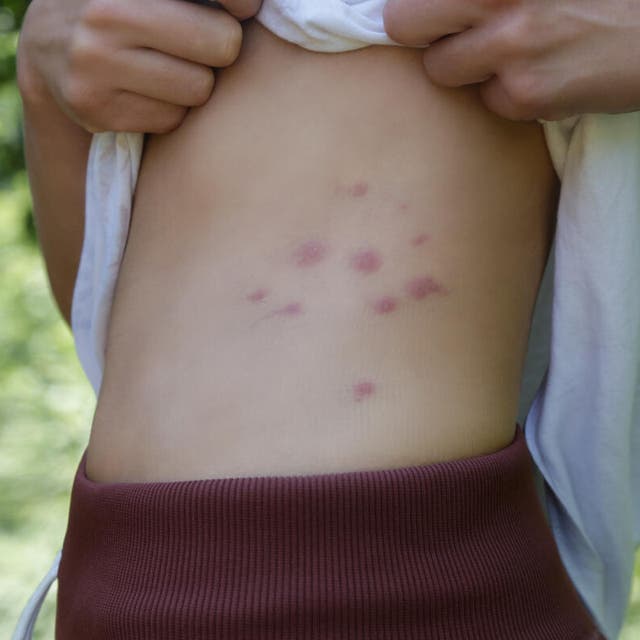pessoa com várias picadas de percevejo na lateral da barriga 
